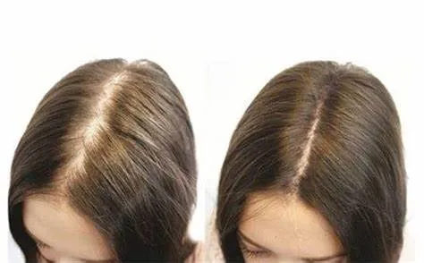 Các phương pháp điều trị y tế: Thuốc, liệu pháp laser, cấy tóc