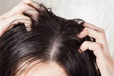 Tại sao tóc bạn lại nhanh bị dầu?