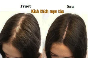 Cách kích thích mọc tóc nhanh