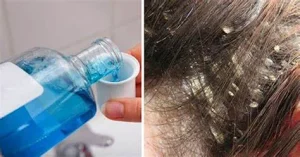 Cách trị gàu tại nhà hiệu quả
